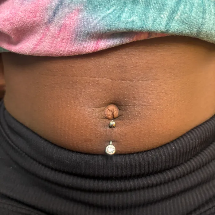 Healed bellybutton piercing, second angle
